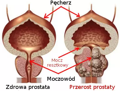 oczyszczanie prostaty)