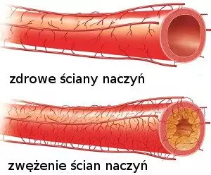 Zwężenie naczyń - zdjęcie 