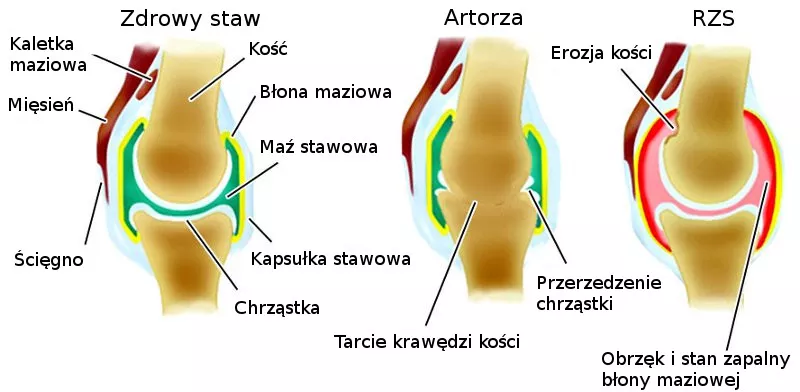artroza koljena s liječenjem deformiteta